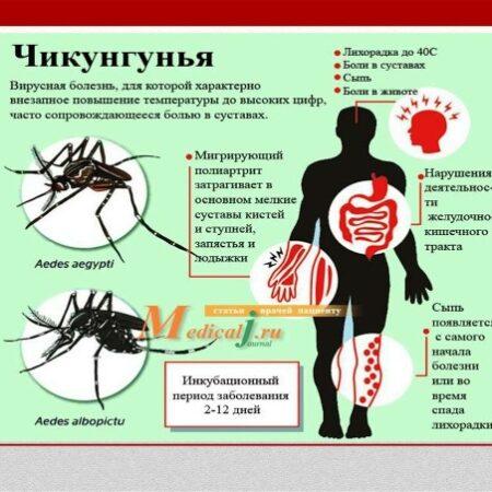 Чикунгунья: есть ли угроза для России и как защититься