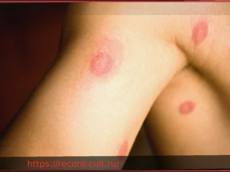 Кожный грибок: как распознать и эффективно бороться с ним