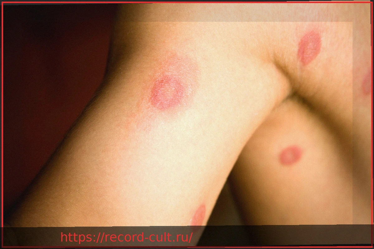 Preview Кожный грибок: как распознать и эффективно бороться с ним