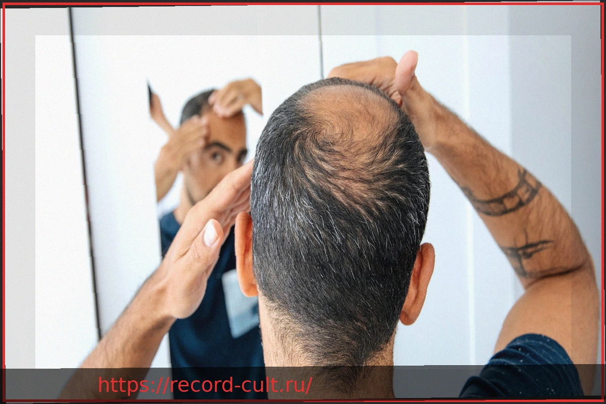 Preview Миноксидил: Что может предложить это активное вещество против выпадения волос