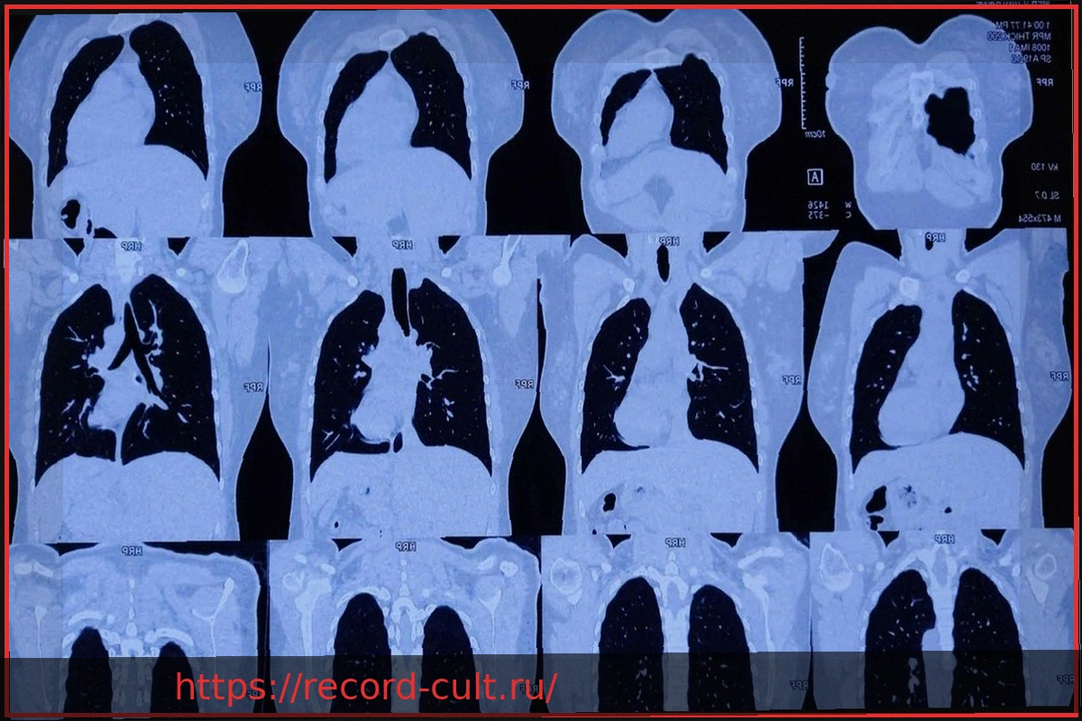 Preview Скрининг рака легких для курильщиков начнется в апреле 2026 года