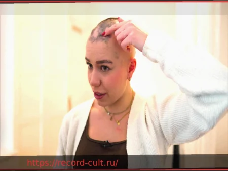 Очаговая алопеция: как стресс влияет на корни волос