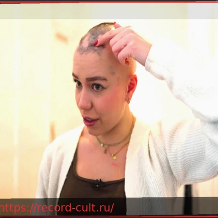 Очаговая алопеция: как стресс влияет на корни волос
