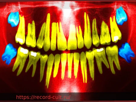 Удаление зубов мудрости: когда это необходимо