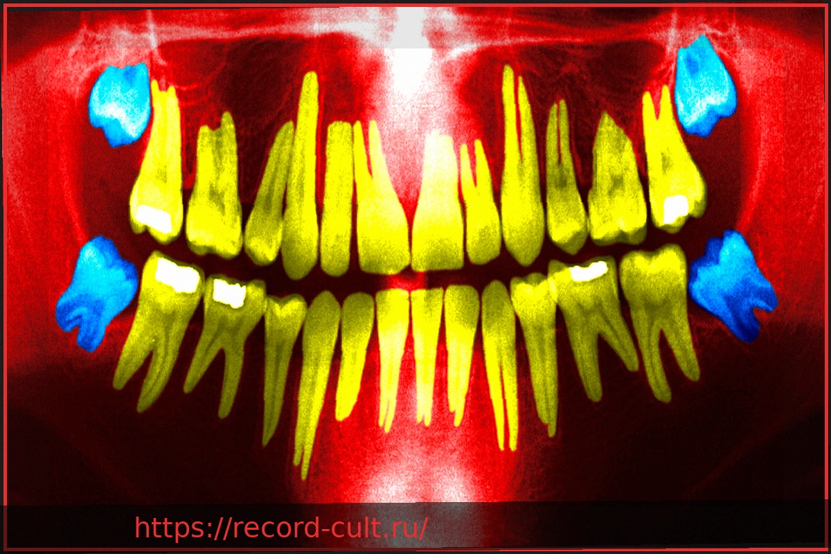 Preview Удаление зубов мудрости: когда это необходимо