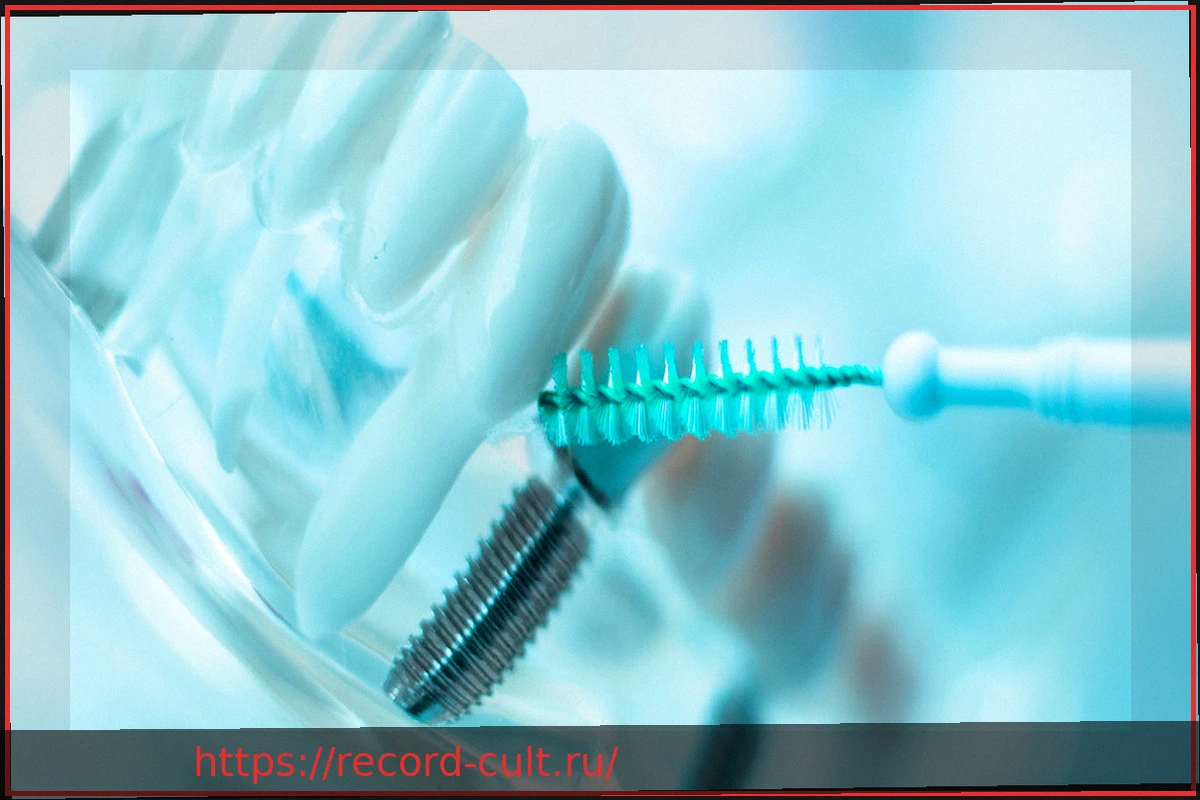 Preview Как предотвратить воспаление зубного имплантата