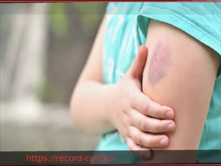 Синяки у ребенка: Знания родителей о гемофилии