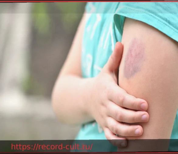 Синяки у ребенка: Знания родителей о гемофилии