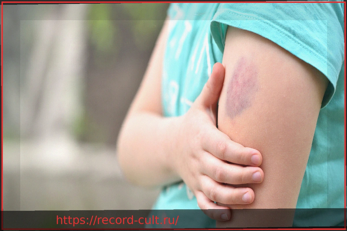 Preview Синяки у ребенка: Знания родителей о гемофилии